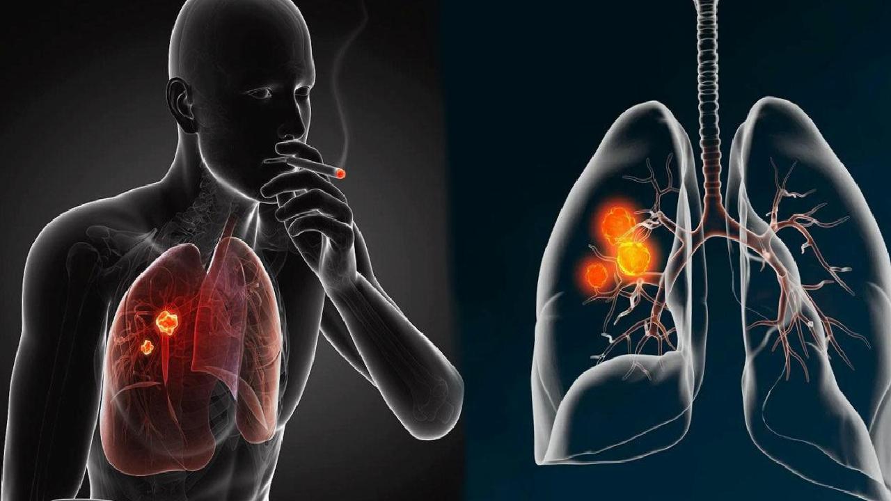 Akciğer Kanserinden Korunma Yolları