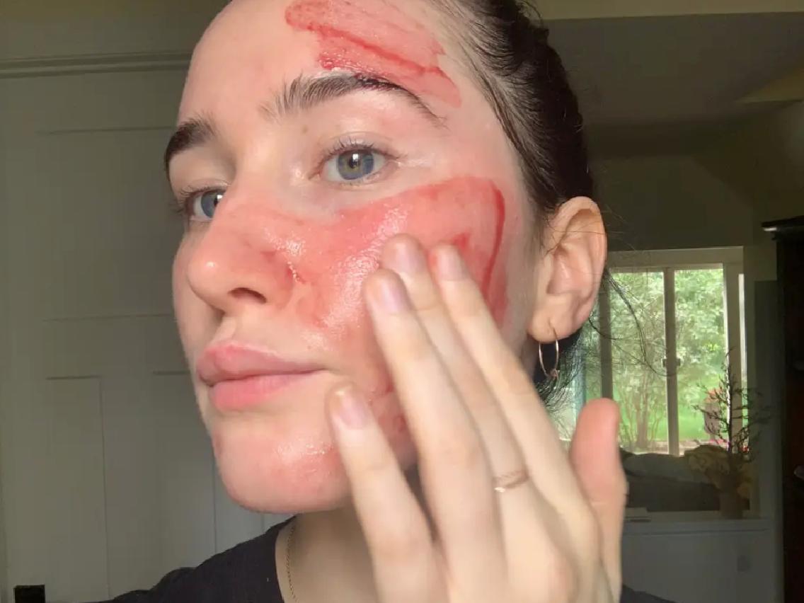 Kırmızı Peelingin Faydaları Nelerdir?