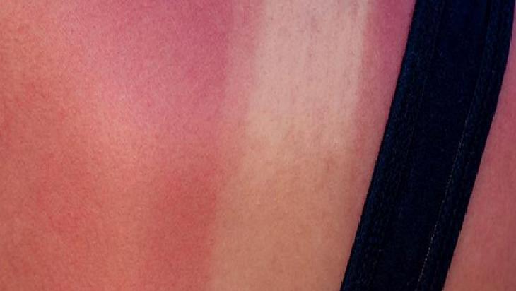 Güneş Kremi Seçerken Dikkat Edilmesi Gerekenler