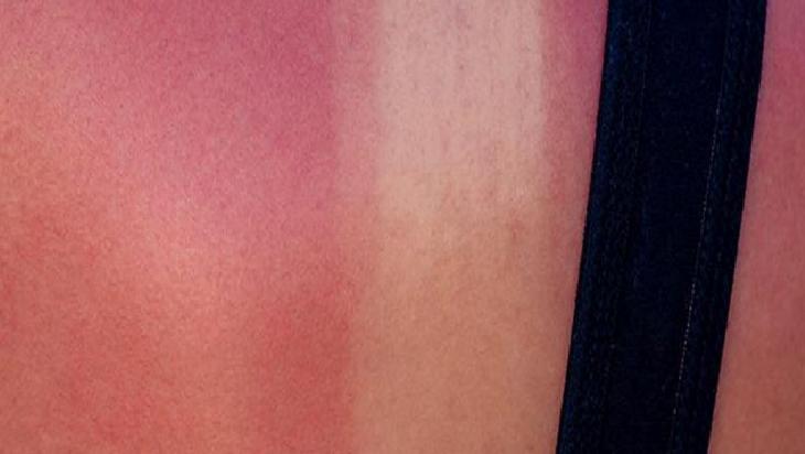 Güneş Kremleri ve Cilt Koruma: SPF'nin Önemi