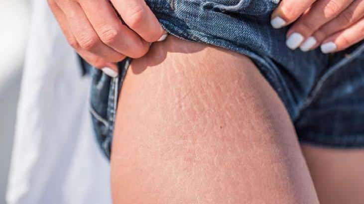 Selülit ile Mücadele: Doğal Yosun Maskeleri