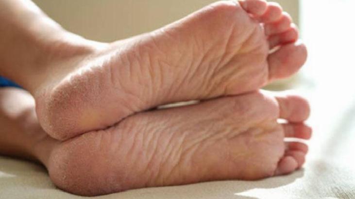 Ayak Mantarının Nedenleri ve Tedavi Yöntemleri