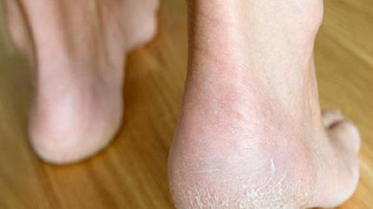 Ayak Mantarı: Nedenleri ve Tedavi Yöntemleri