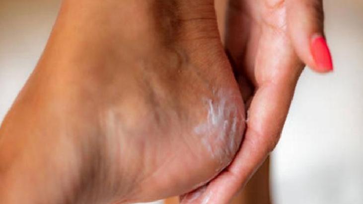 Ayak Mantarı: Nedenleri ve Tedavi Yöntemleri
