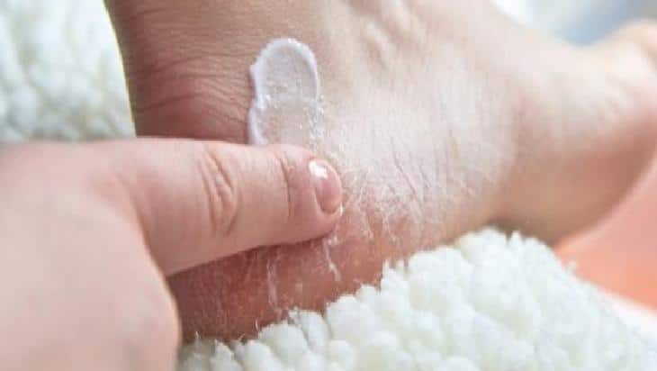 Nasırdan Kurtulmanın Doğal Yöntemleri