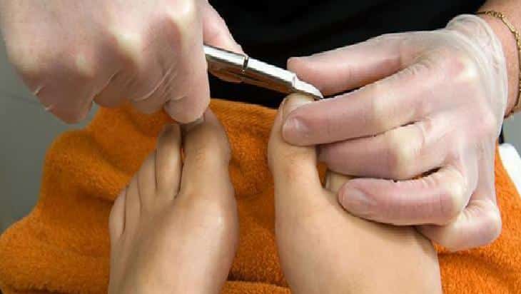 Nasırdan Kurtulmanın Doğal Yöntemleri