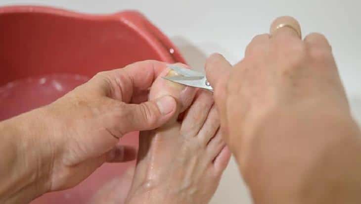 Nasırdan Kurtulmanın Doğal Yöntemleri