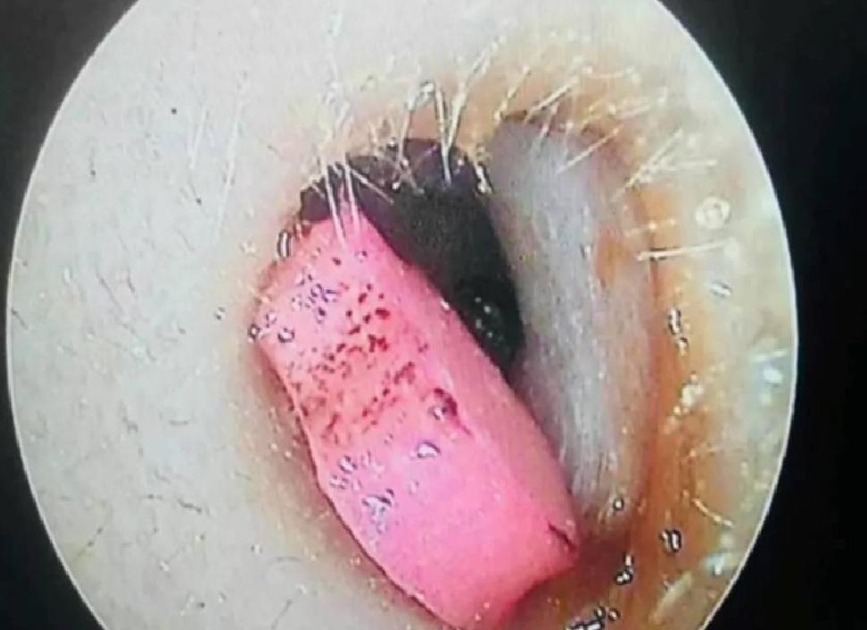 5 Yaşındaki Çocukta Kulaktan Silgi Çıktı