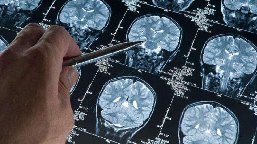 Alzheimer'ı Tespit Etme Yöntemlerinde Yenilikçi Yaklaşımlar