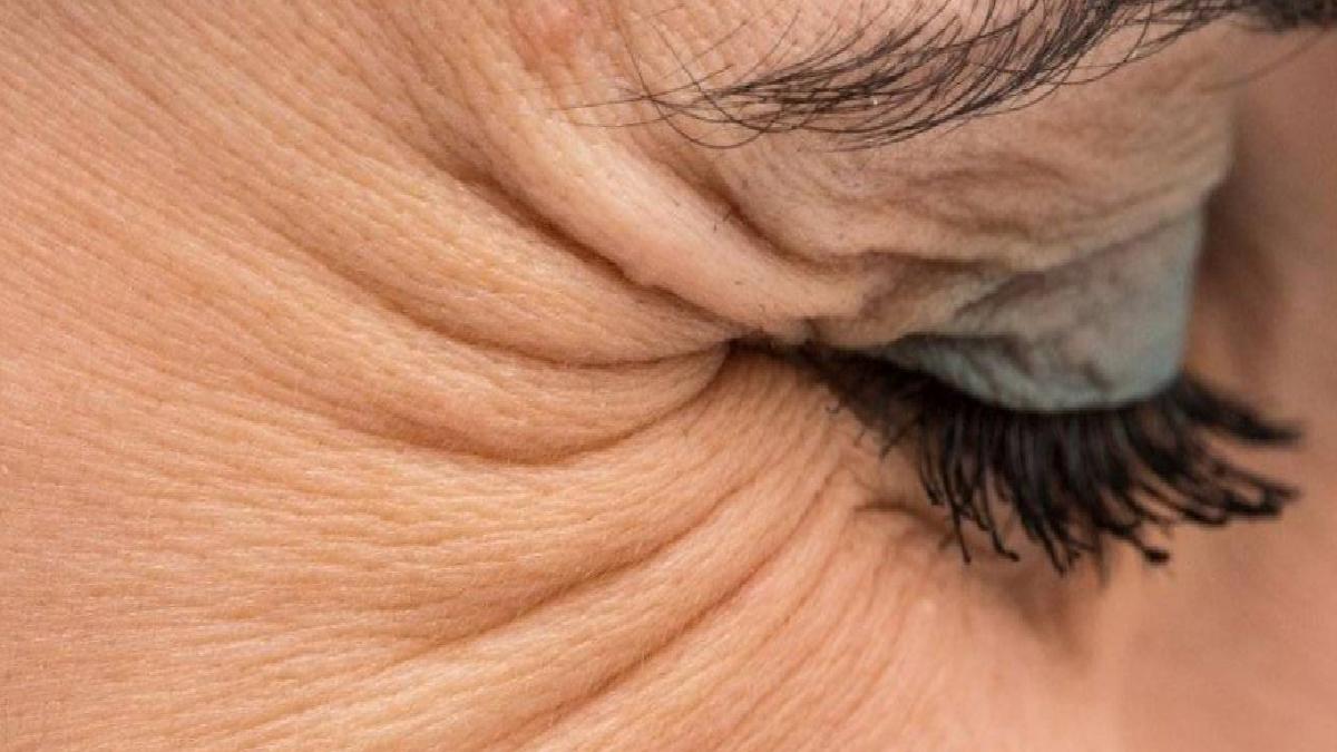 Yaş Aralıklarına Göre Kırışıklıkların Gelişimi