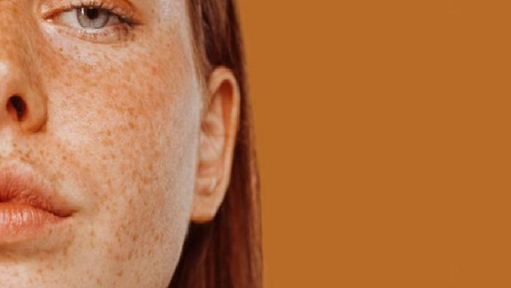 Doğal Yöntemlerle Cilt Lekeleri ile Mücadele