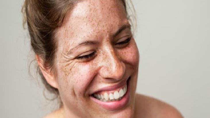 Doğal Yöntemlerle Cilt Lekeleri ile Mücadele