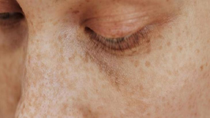 Doğal Yöntemlerle Cilt Lekeleri ile Mücadele