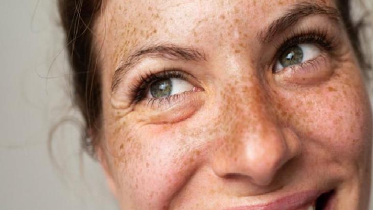 Doğal Yöntemlerle Cilt Lekeleri ile Mücadele