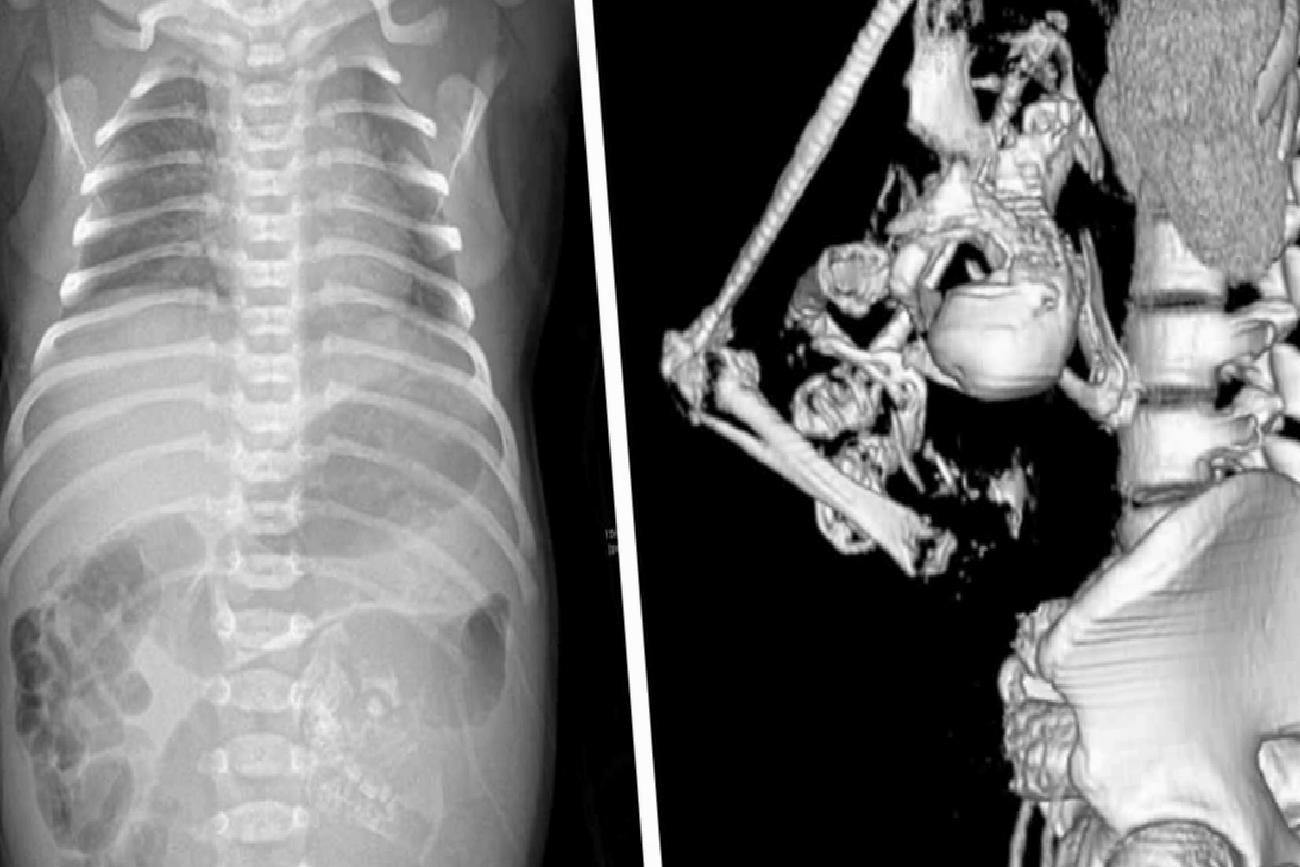 Hindistan'da Eşine Az Rastlanan Doğum Olayı: Karnında İkiz Fetüsü Taşıyan Bebek