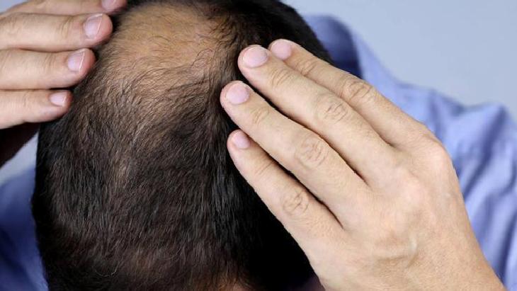 Saç Dökülmesi Nedenleri ve Biberiye Yağının Faydaları