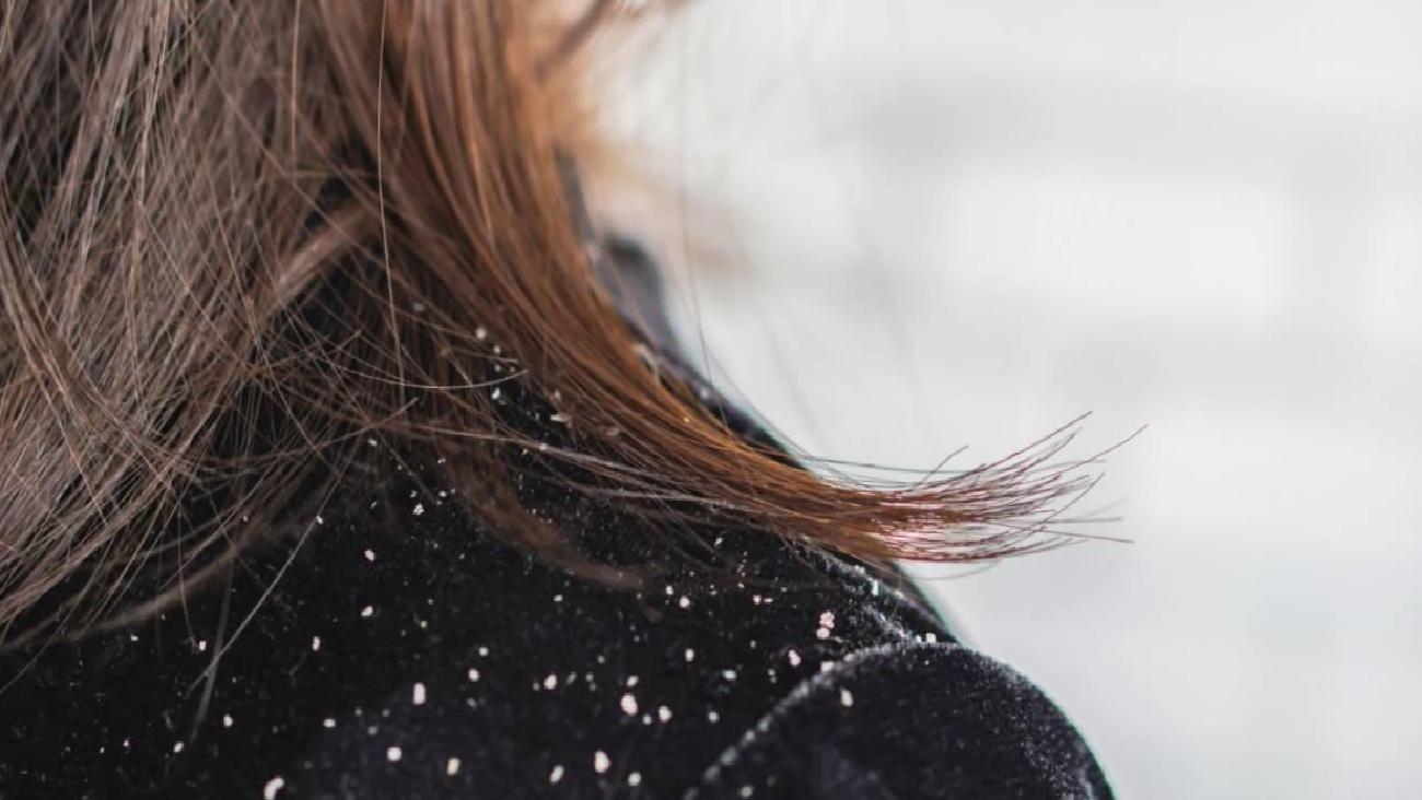 Saç Kepeklenmesi ve Etkili Şampuanlar