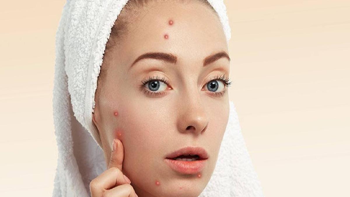 Sivilce Bantları: Etkili Mi, Gerçekten İşe Yarıyor mu?