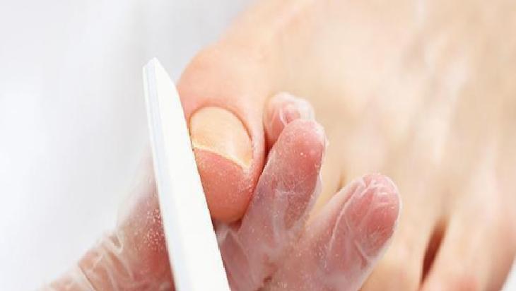 Batık Tırnak Tedavisi için Doğal Yöntemler