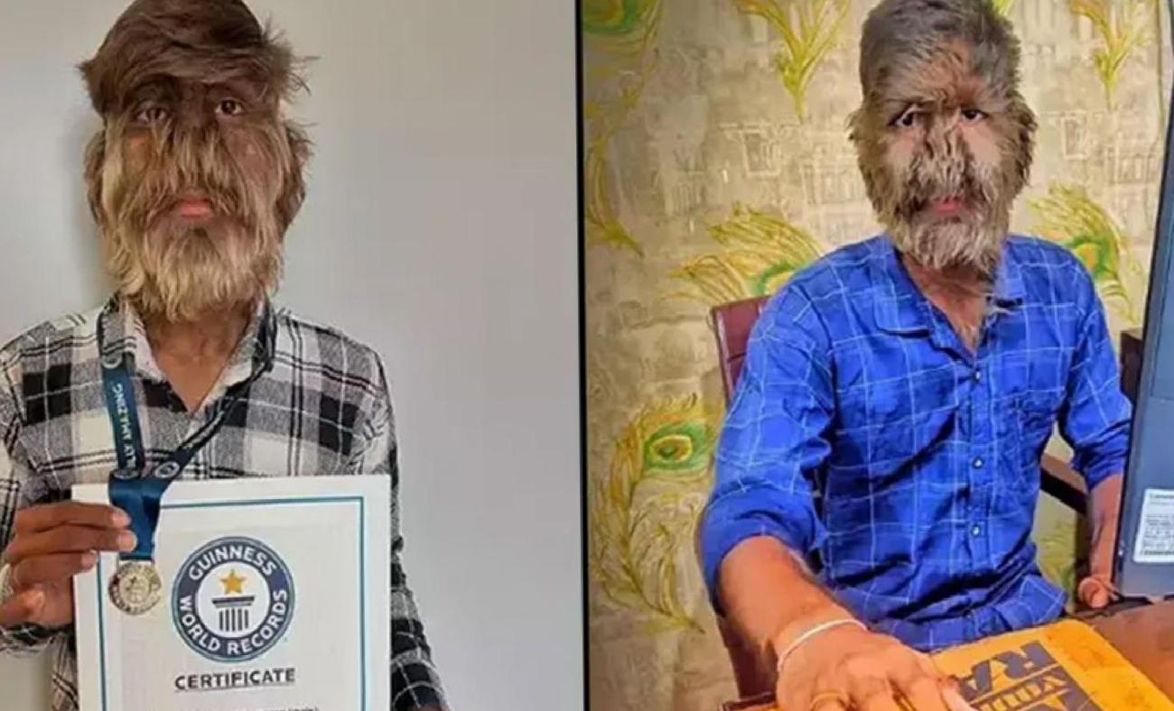 Hipertrikoz Vakası: Lalit Patidar'ın Hikayesi