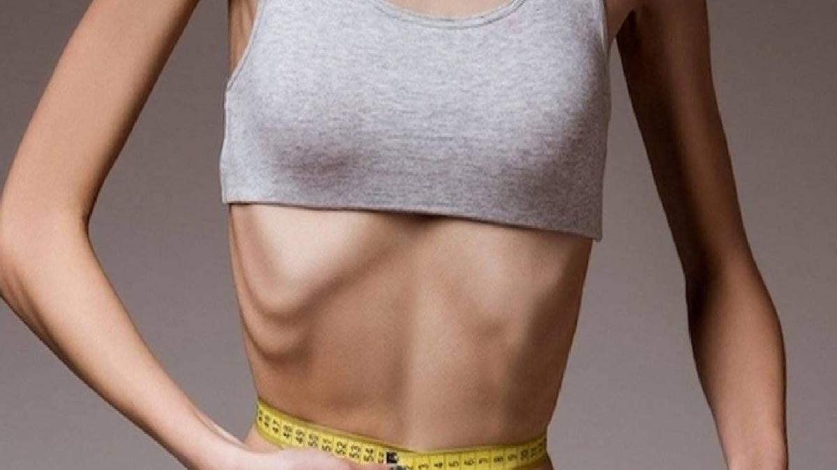 Anoreksiya Nervoza Nasıl Tedavi Edilir?