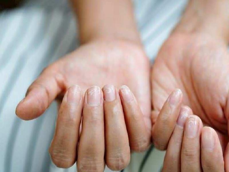 Tırnaklardaki Belirtiler ve Kanser Riski