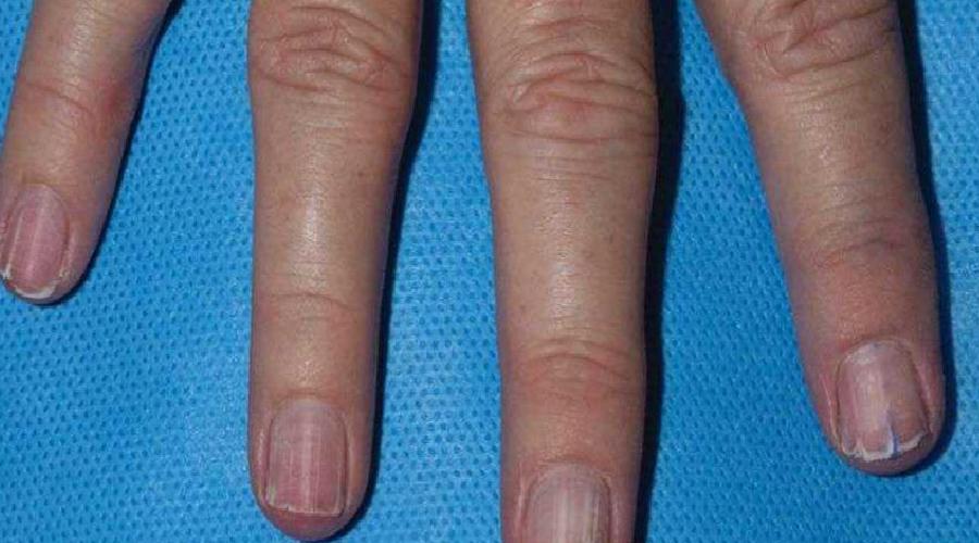 Melanom ve Erken Teşhisin Önemi