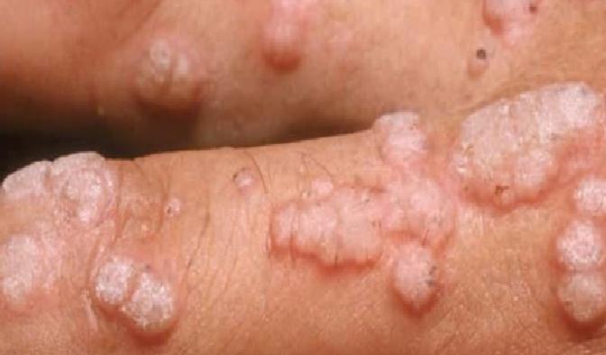 HPV Aşısı ve HPV Enfeksiyonu Hakkında Detaylı Bilgi