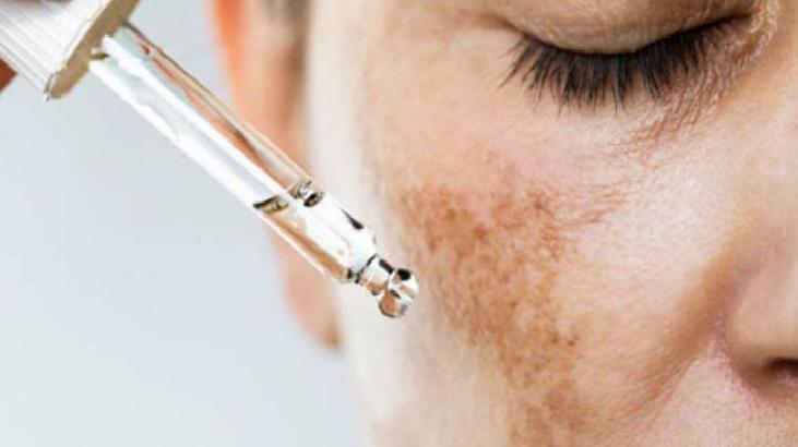 Güneş Lekeleri ve Doğal Çözüm