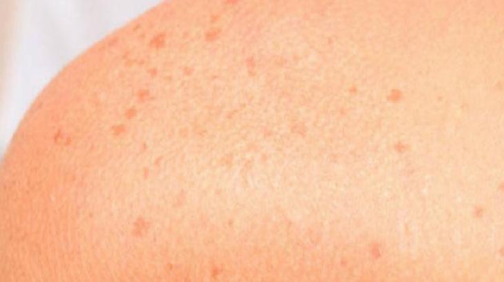 İbn-i Sina’nın Cilt Lekeleri İçin Tavsiyesi