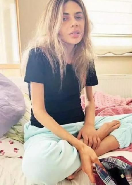 Anoreksiya Nervoza ile Başa Çıkış Süreci