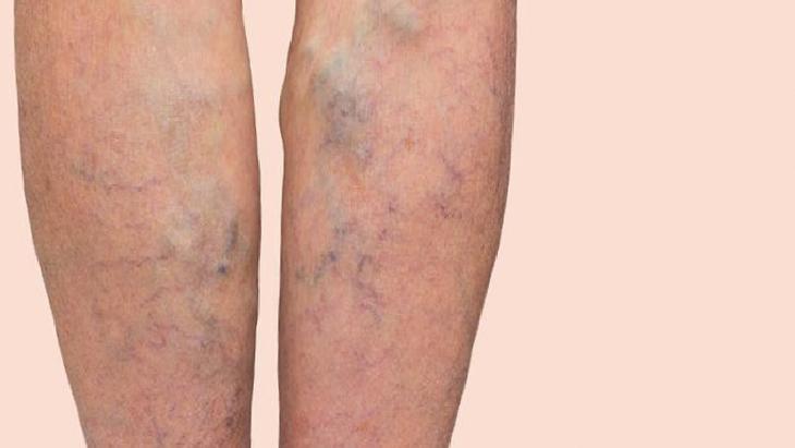 Varis Sorunlarında Kontrol ve Korunma Yöntemleri