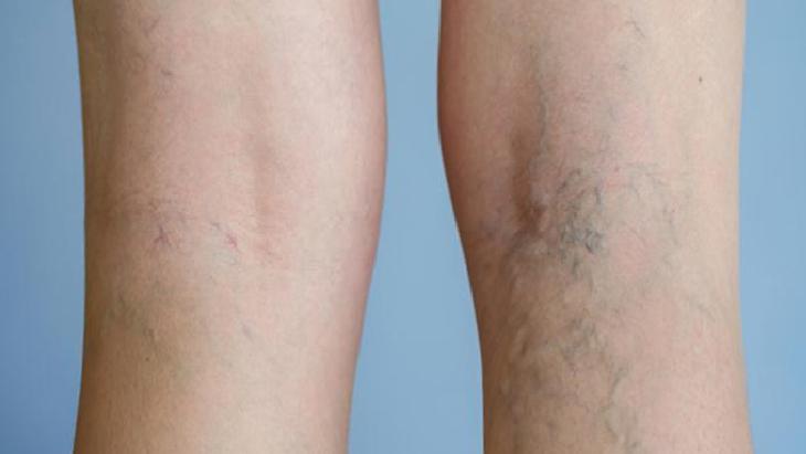 Varis Sorunlarında Kontrol ve Korunma Yöntemleri