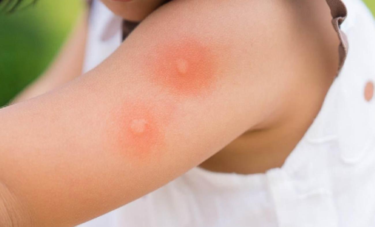 Yaz Aylarının Gelişi ve Sivrisinekler