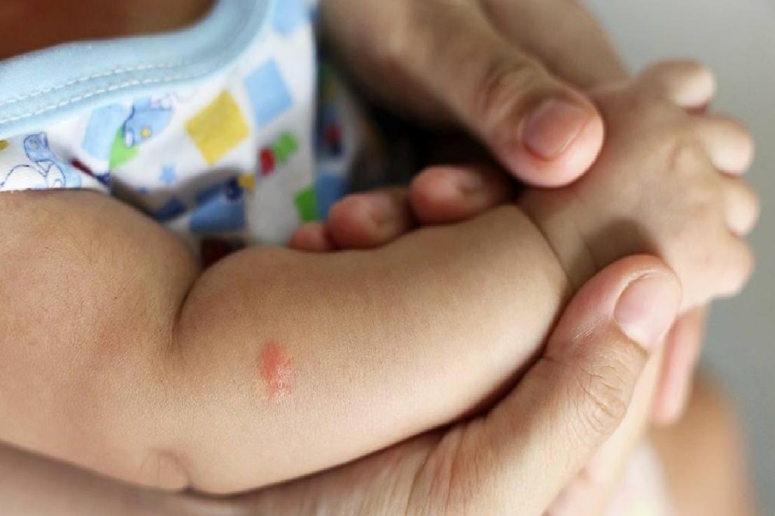 Sivrisinek Isırıklarının Tedavisi