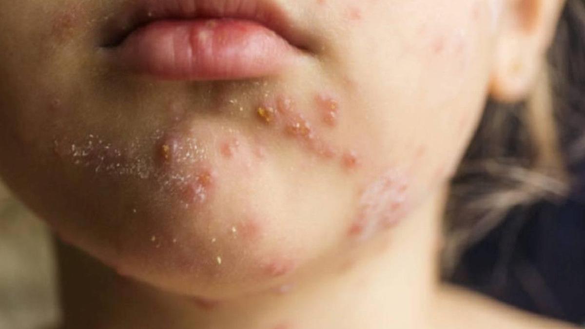 Amerika'da Kızamık Vakalarında Büyük Artış