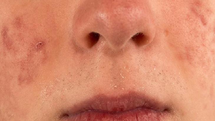 Cildinizi Kusursuz Gösterme Trendleri ve Uyarılar