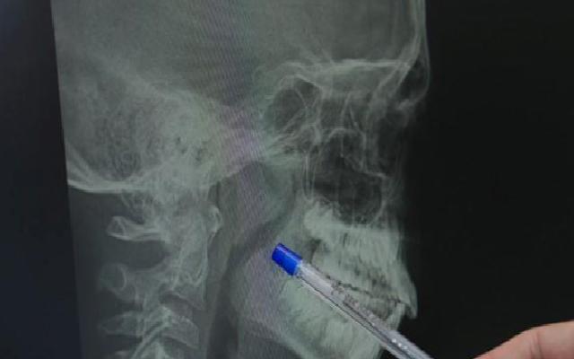 Gelişimi Olumsuz Etkileyen Bademcik ve Geniz Eti Sorunları