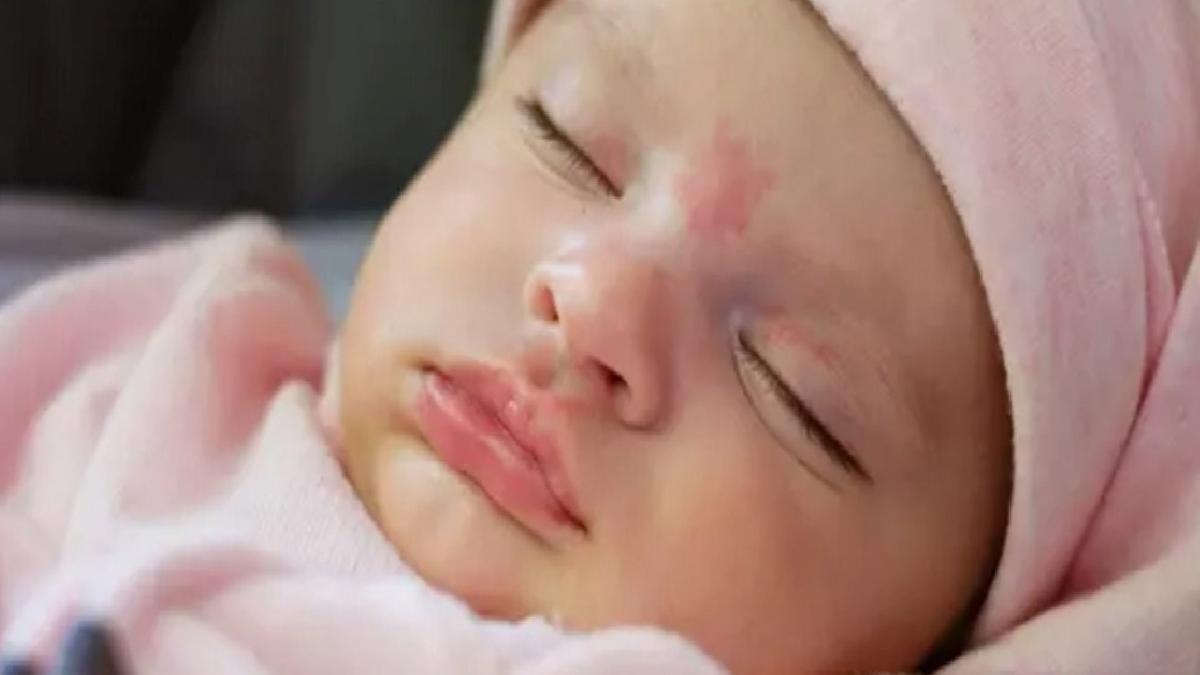 Doğum Lekeleri Nedir?