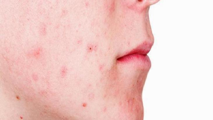 Yaz Aylarında Ciltteki Yağ Artışının Nedenleri ve Sonuçları