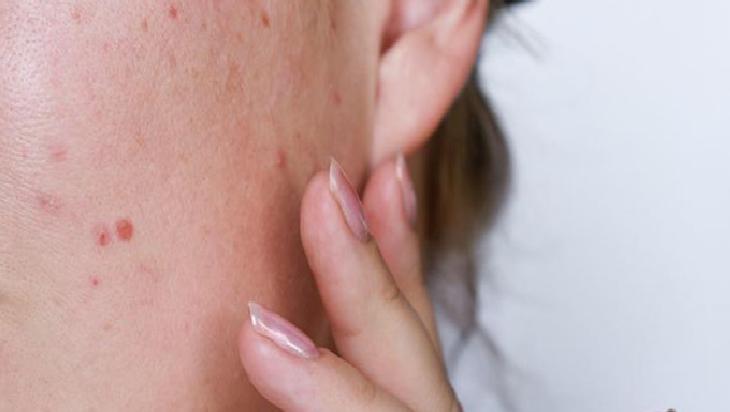 Yaz Aylarında Cilt Bakımı ve Akneyle Mücadele Yöntemleri