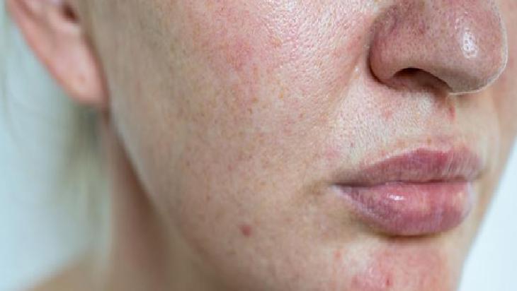 Estetik sonrası pişmanlık yaşamayın! En sık yapılan hata, cildi mahvediyormuş