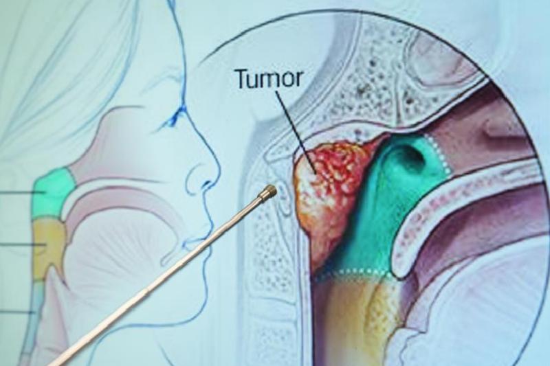 Sessiz ilerleyen Geniz kanserine karşı uyarı: Geç Kalmayın