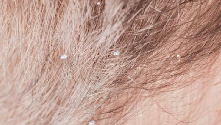 Yaz kepeğiye başa çıkmak çok kolay! Saçların kurtarıcısı: 3 yağlı çözüm yetiyor