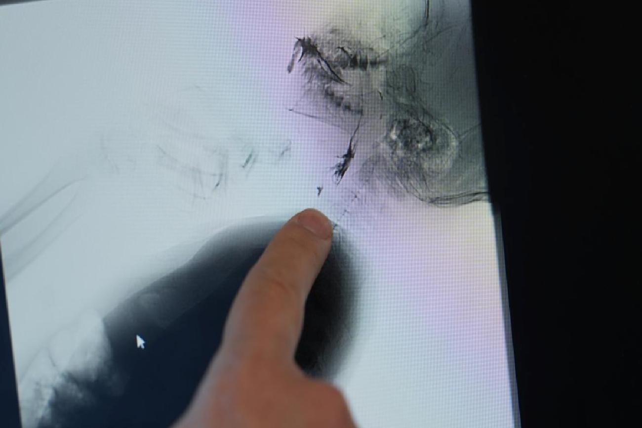 Yutma bozukluğuna dikkat: Çocuklarda Yutma bozukluğu belirtileri