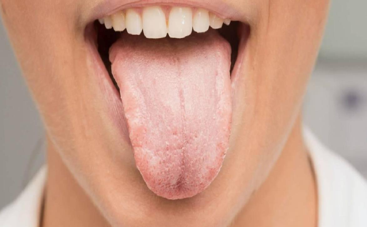 İngiltere'de Dil Kanseri: Grace Brand'in Yaşamını Değiştiren Bir Hikâye