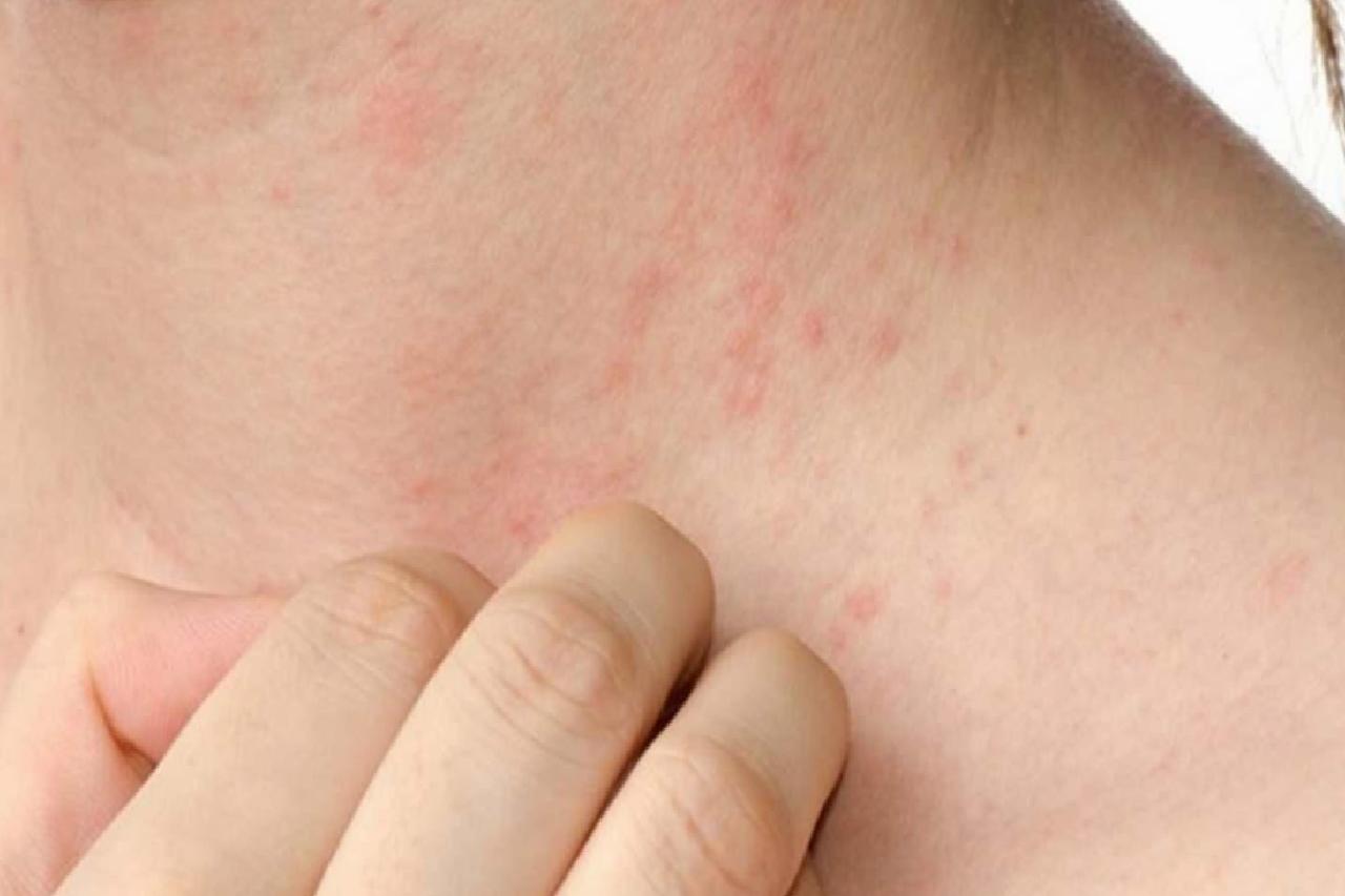 Okul Çağında Besin Alerjisi: Ailelerden Okula, Öğretmenlerden Mutfağa Kadar Alınması Gereken Tedbirler