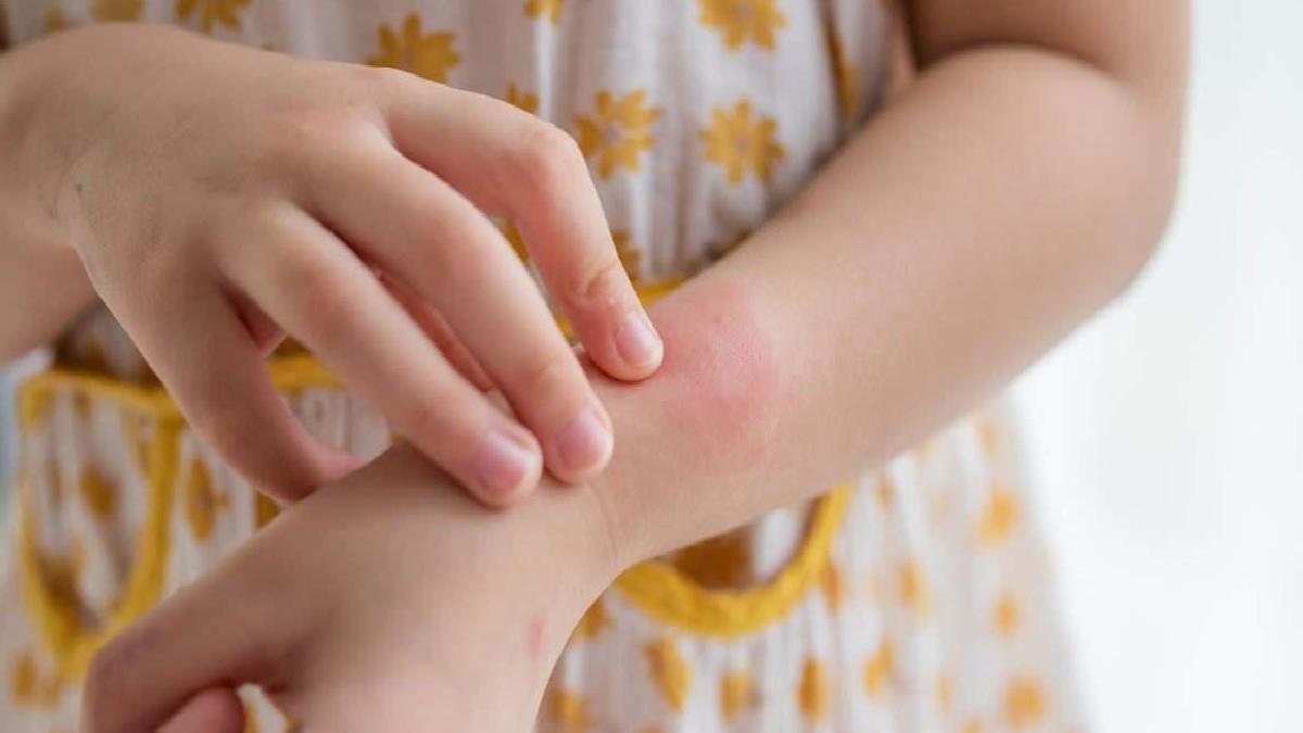 Okul Çağında Besin Alerjisi: Ailelerden Okula, Öğretmenlerden Mutfağa Kadar Alınması Gereken Tedbirler