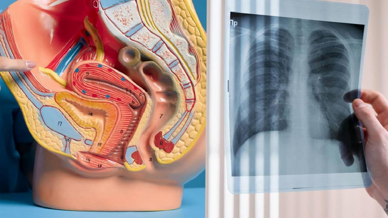 Plevral Efüzyonda Sıvı Boşaltımı ve Cerrahi Yaklaşımlar: VATS ile Kalıcı Çözüm