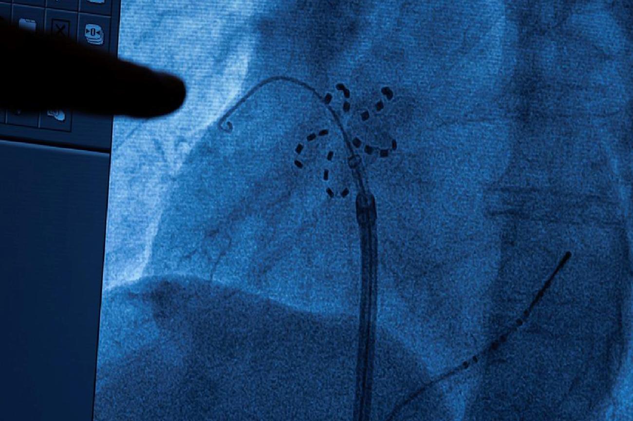 Pulsed Field Ablation (PFA): Ritim Bozukluklarında Yeni Nesil Güvenli Çözüm